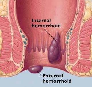 Външни и вътрешни хемороиди