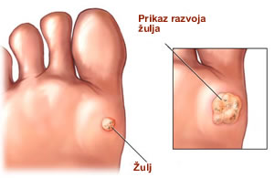 Мехури по стъпалата